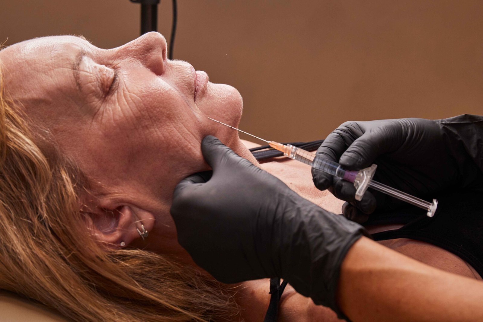 Professional marionette line filler procedure performed at an aesthetic clinic in Manchester