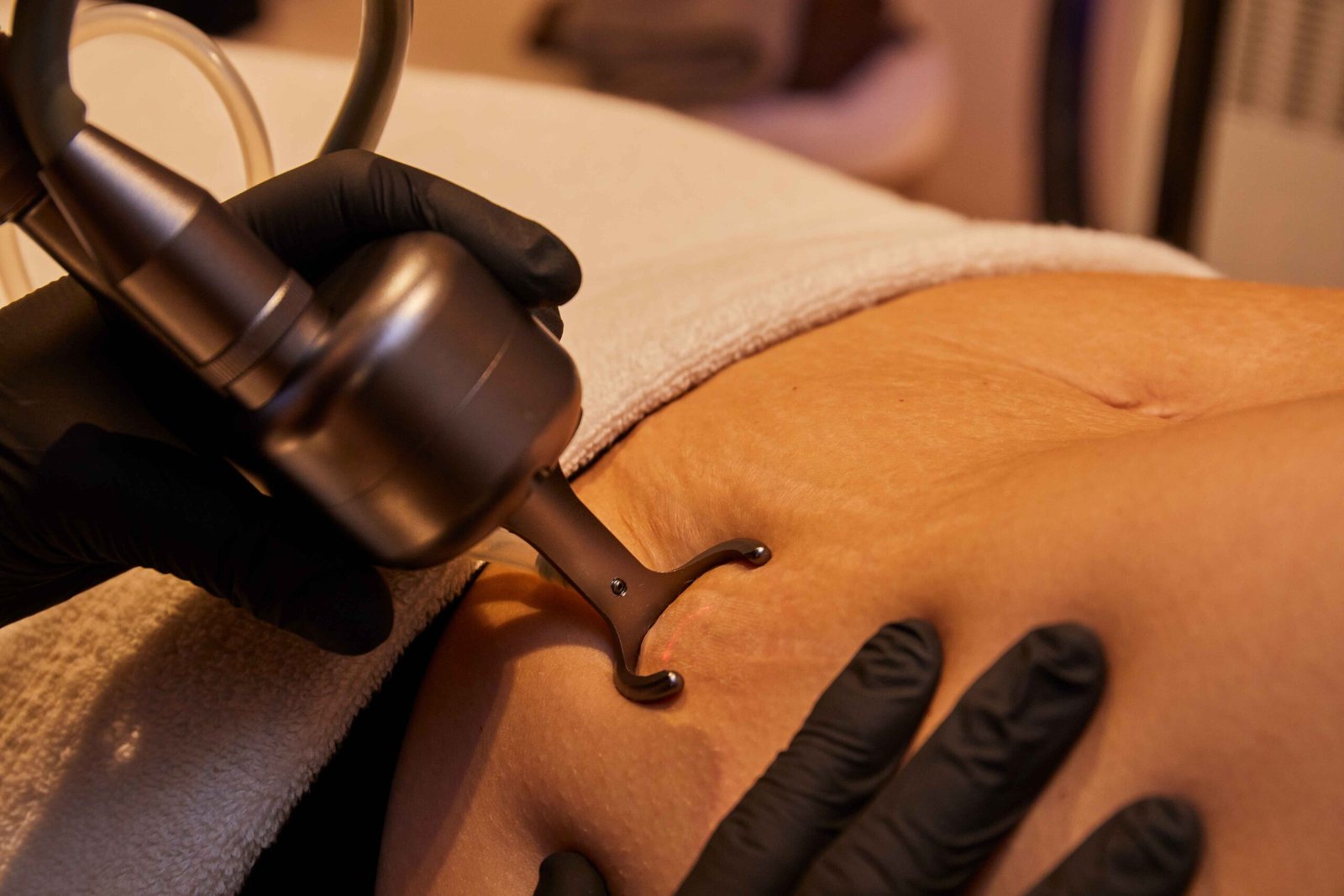 CO2 laser stretch mark removal treatment on abdomen Manchester Aesthetics clinic