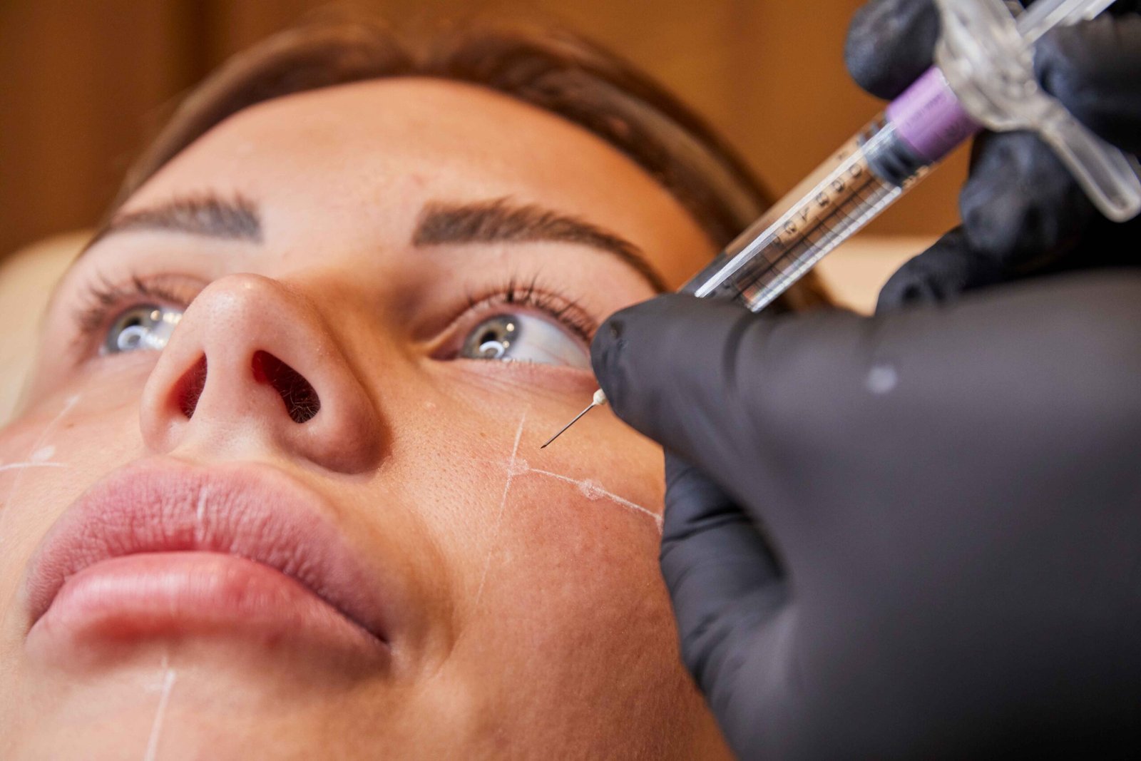 Dermal filler injection for cheek augmentation by expert at Manchester Aesthetics clinic