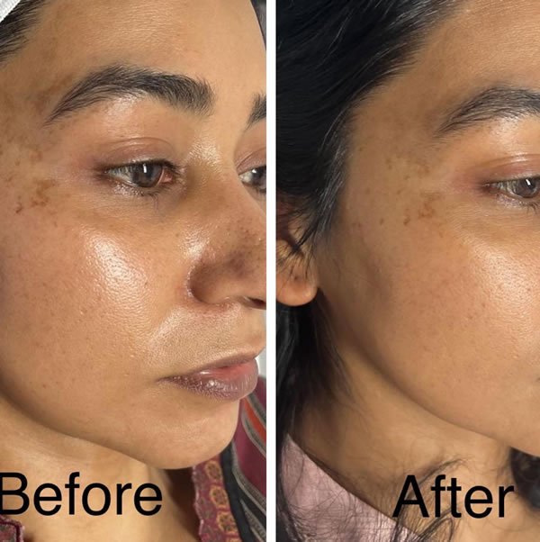 Side-by-side facial images used to illustrate skin appearance before and after a chemical peel treatment in Manchester