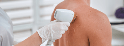 Laser hair removal on shoulder in Manchester