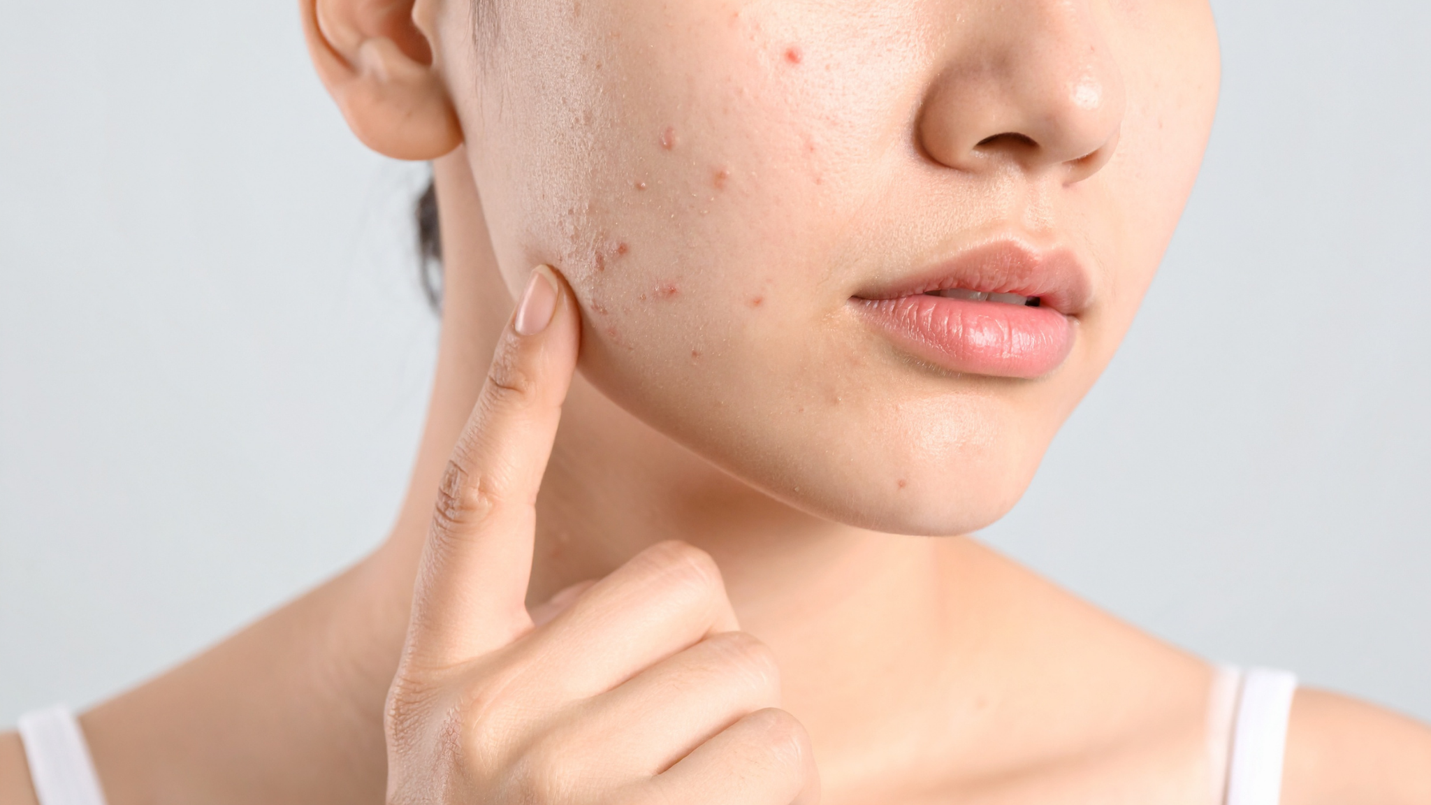 Close-up of facial skin showing acne spots and pigmentation, highlighting concerns treated with laser acne skin treatment in Manchester.