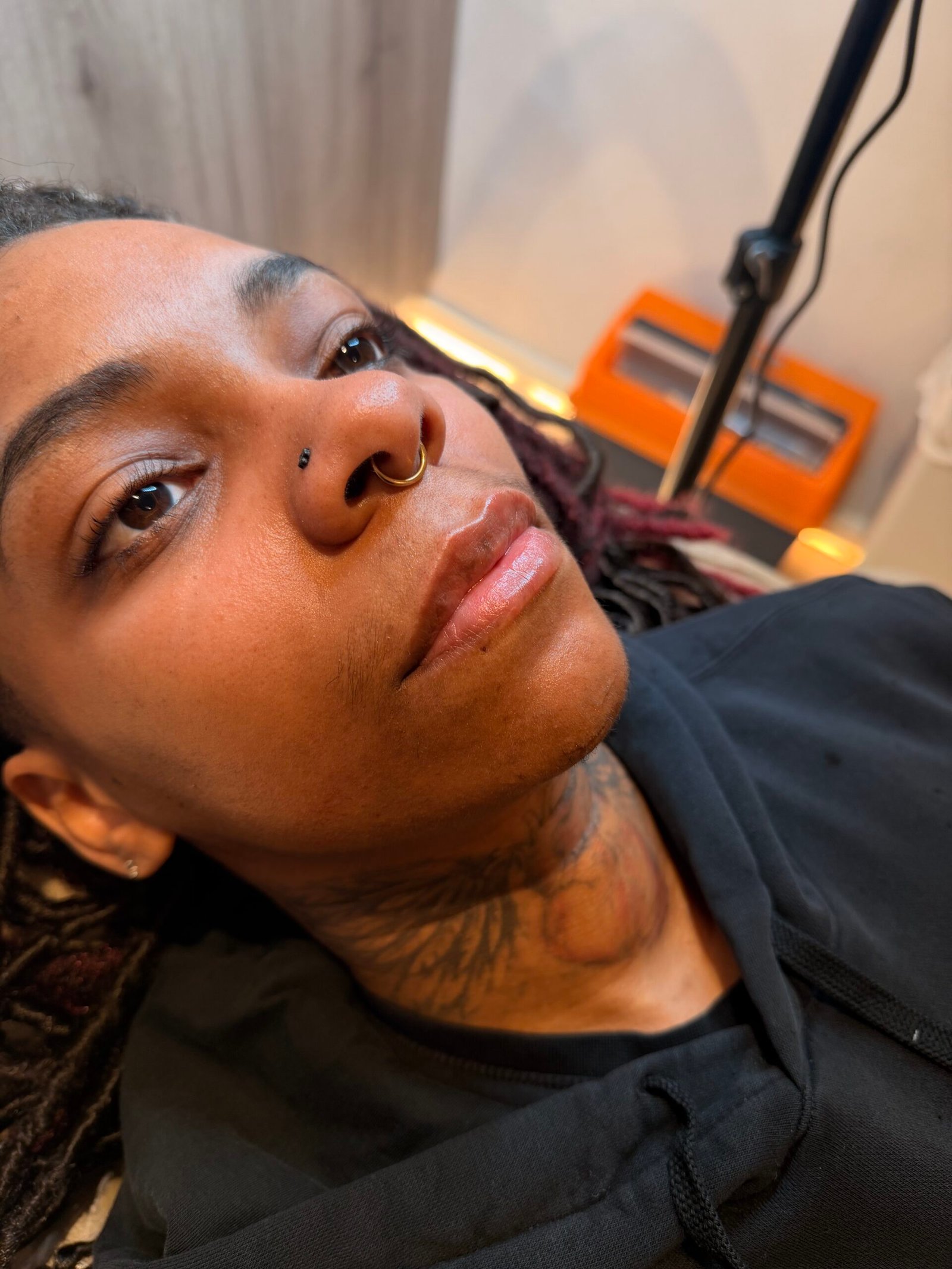 After lip augmentation filler treatment showing fuller, more defined lips with a natural-looking finish.