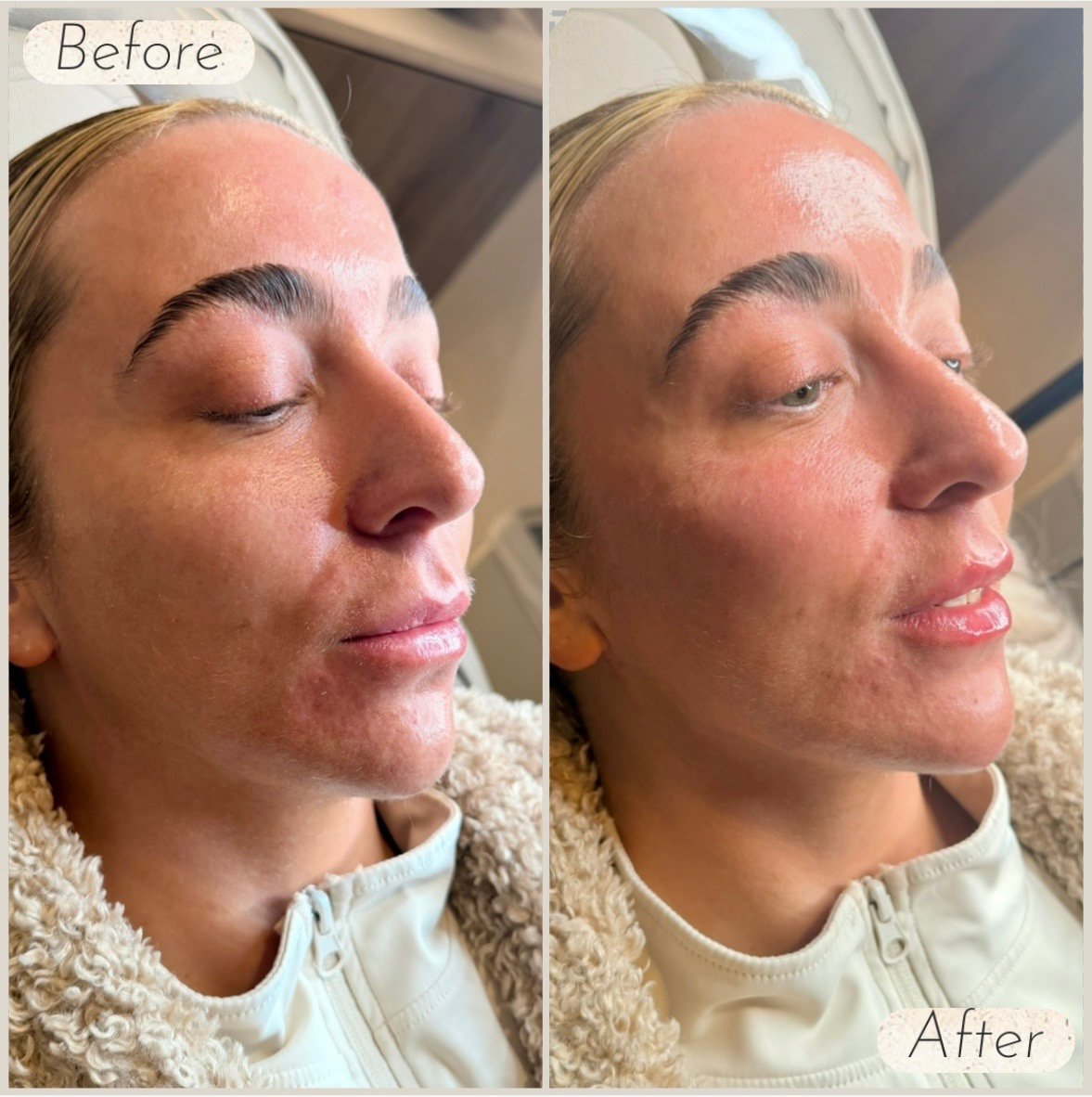 Before and after 4ml filler package treatment showing improved facial balance, enhanced contour and natural-looking definition.