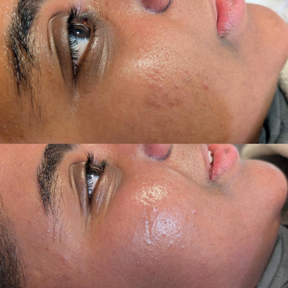 Obagi blue radiance peel treatment results