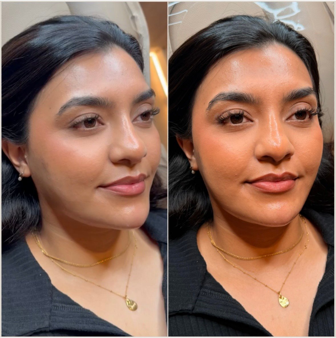 Before and after cheek, chin and jaw augmentation filler treatment showing improved facial contour, enhanced definition and a balanced lower-face profile.