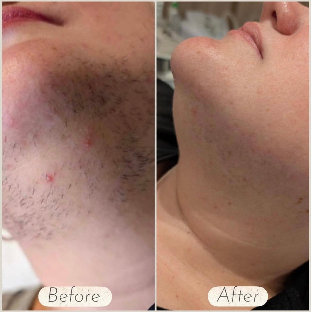 Laser Hair Removal in Manchester