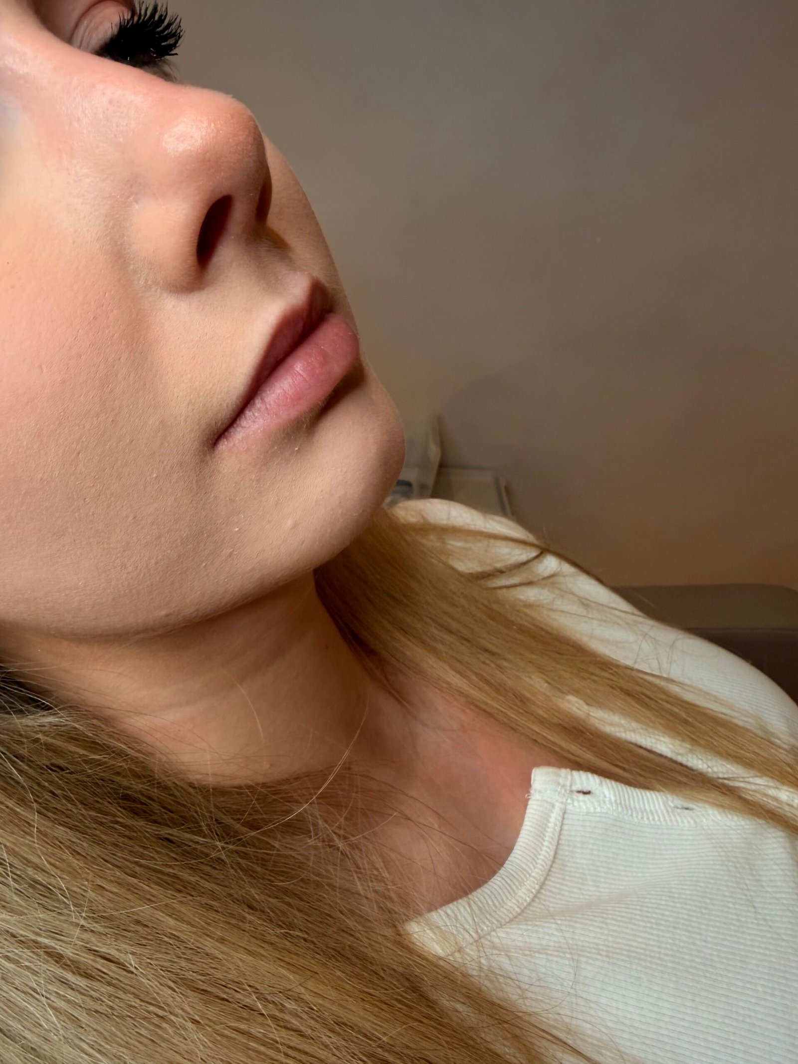 Before lip filler Manchester