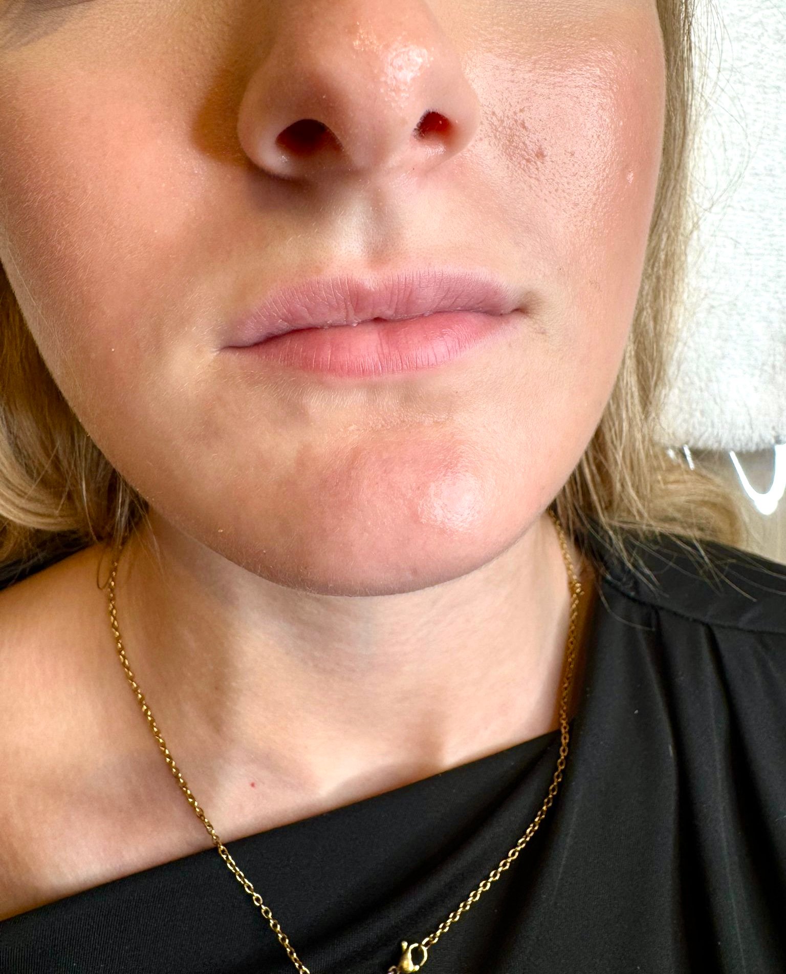 Before natural lip filler treatment image showing the client’s lips prior to treatment.
