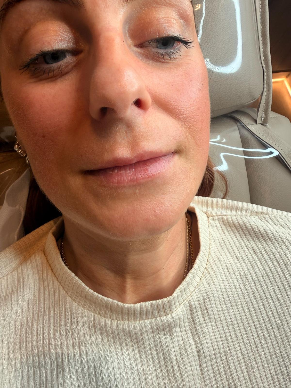 Before lip filler treatment at Manchester Aesthetics showing the lips prior to enhancement.