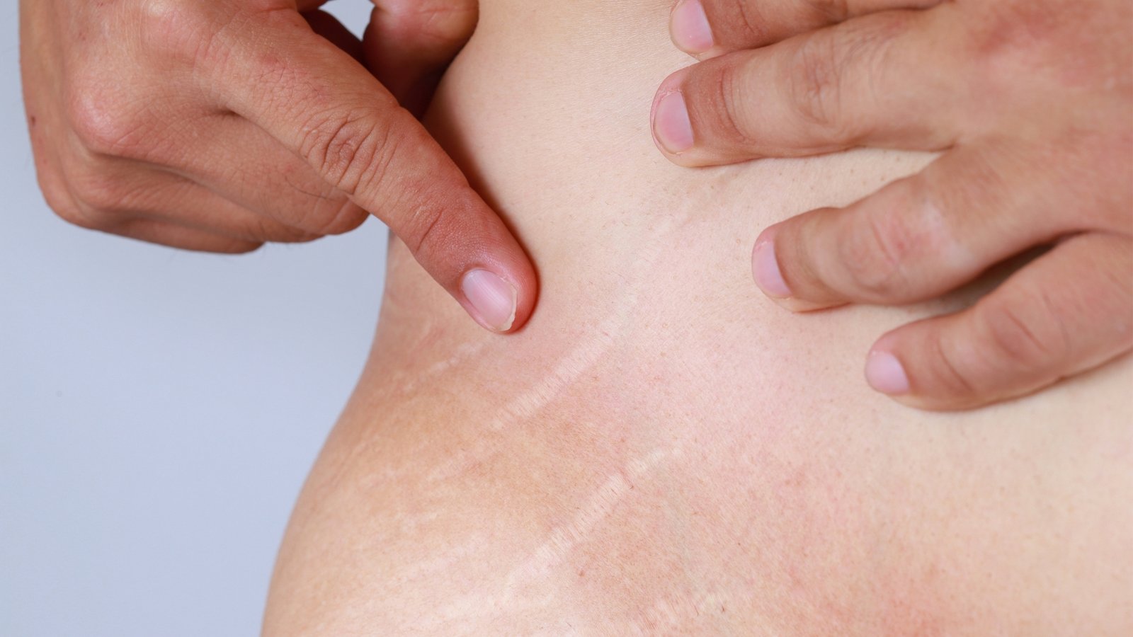 CO2 laser treatment for stretch marks in Manchester