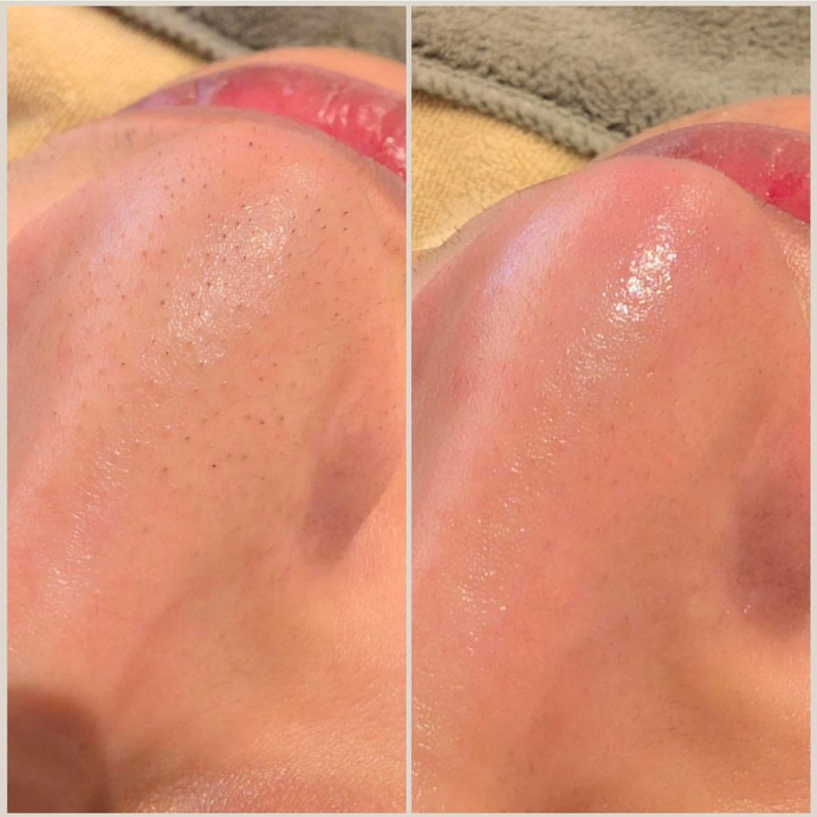 Hydro2 Facial treatment for skin hydration and rejuvenation