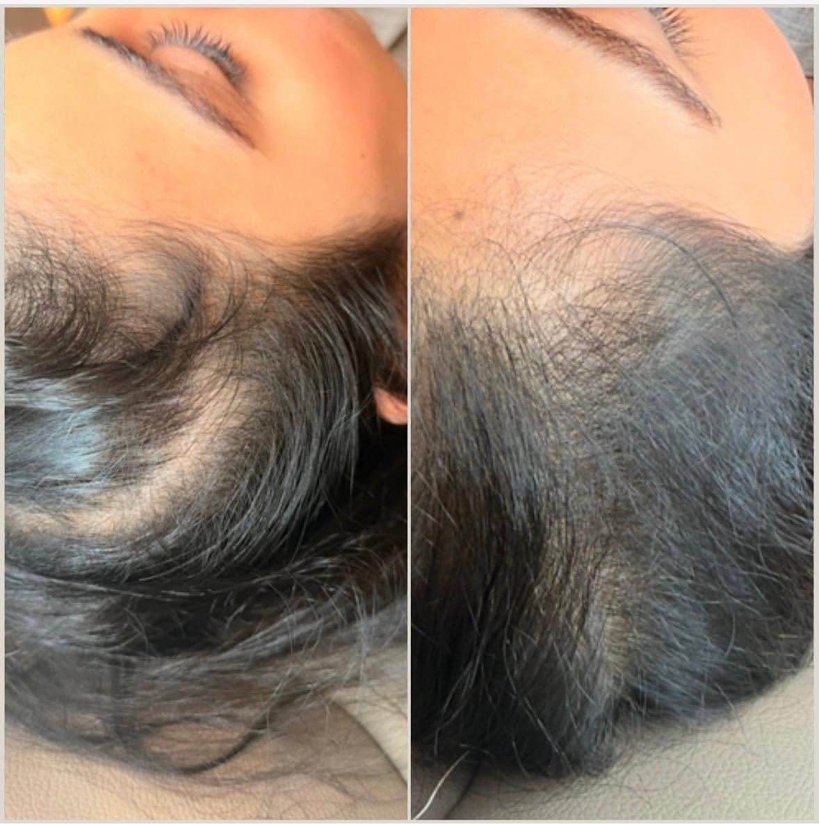 PRP treatment results after one session