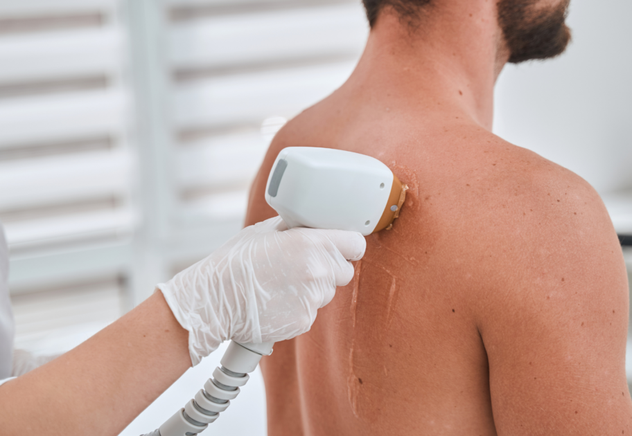 Full body laser hair removal for men