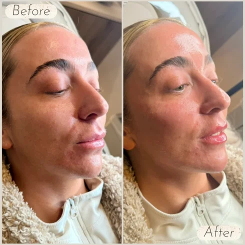 2ml filler package before and after results showing enhanced lips and facial contouring at Manchester Aesthetics Clinic