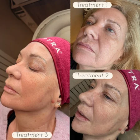 Sculptra before and after treatment results for facial volume and skin rejuvenation at Manchester Aesthetics Clinic