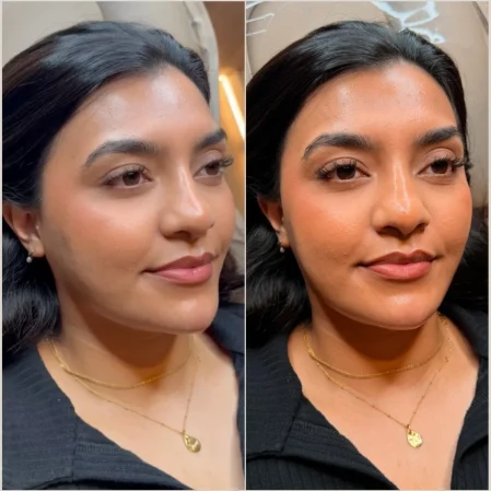Before and after cheek, chin and jaw augmentation filler results at Manchester Aesthetics Clinic