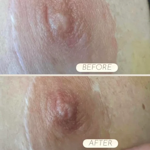 BA-nipple-filler-1-1