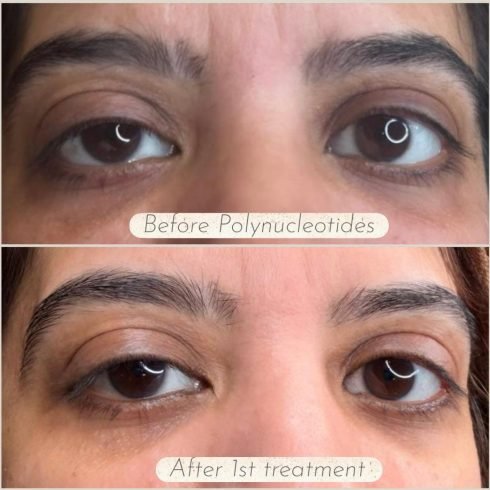 B&A polynucleotides under eye