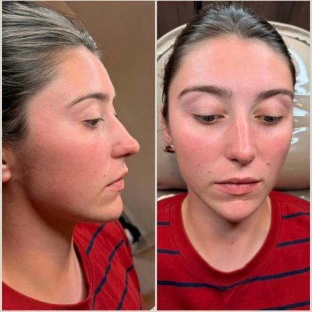 Chin augmentation procedure result